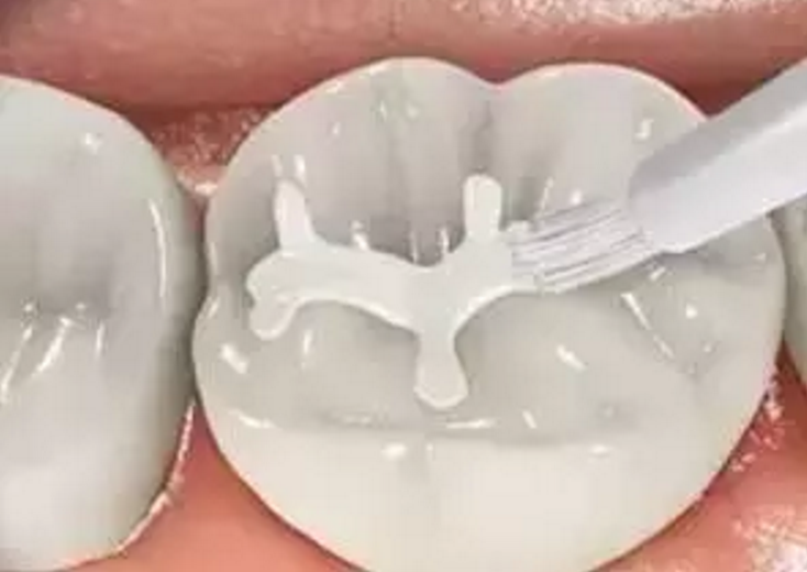深圳宣传片制作公司口腔牙齿的沟隙的方式